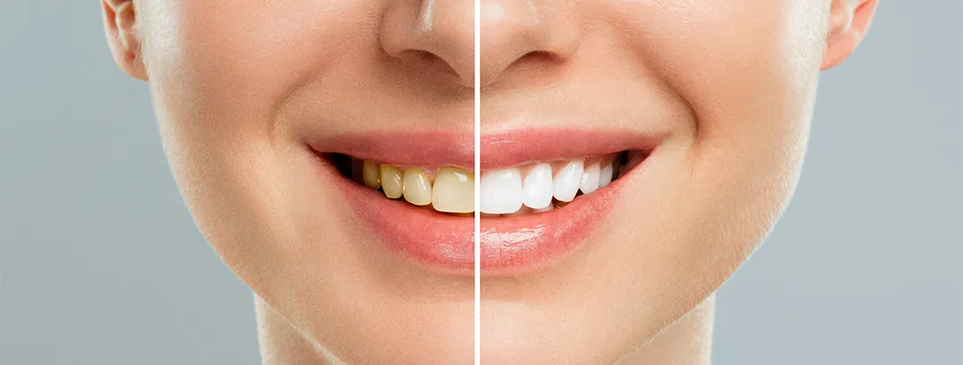 歯医者で行うホワイトニングの特長
