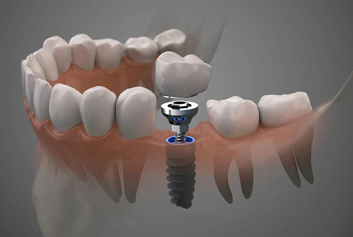 インプラント治療