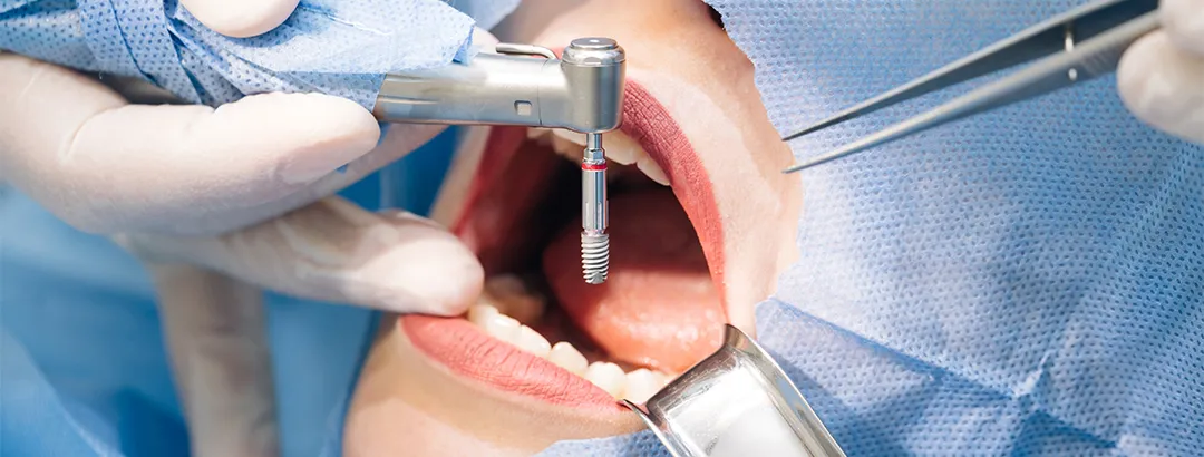 インプラント治療について