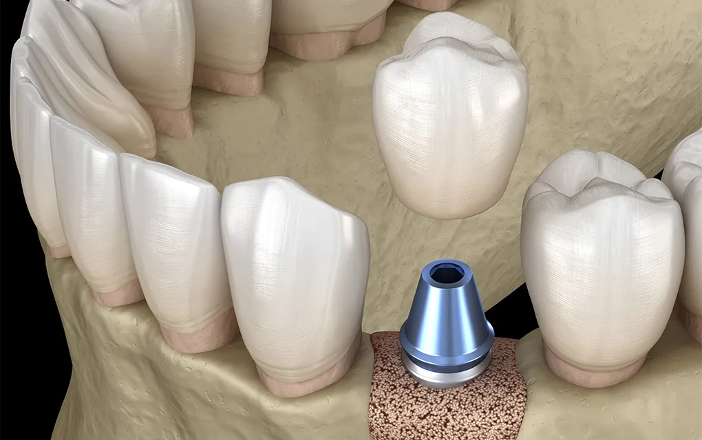 GBR（骨誘導再生法）