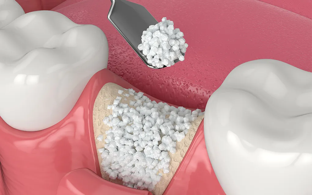 ボーングラフト（骨移植法）