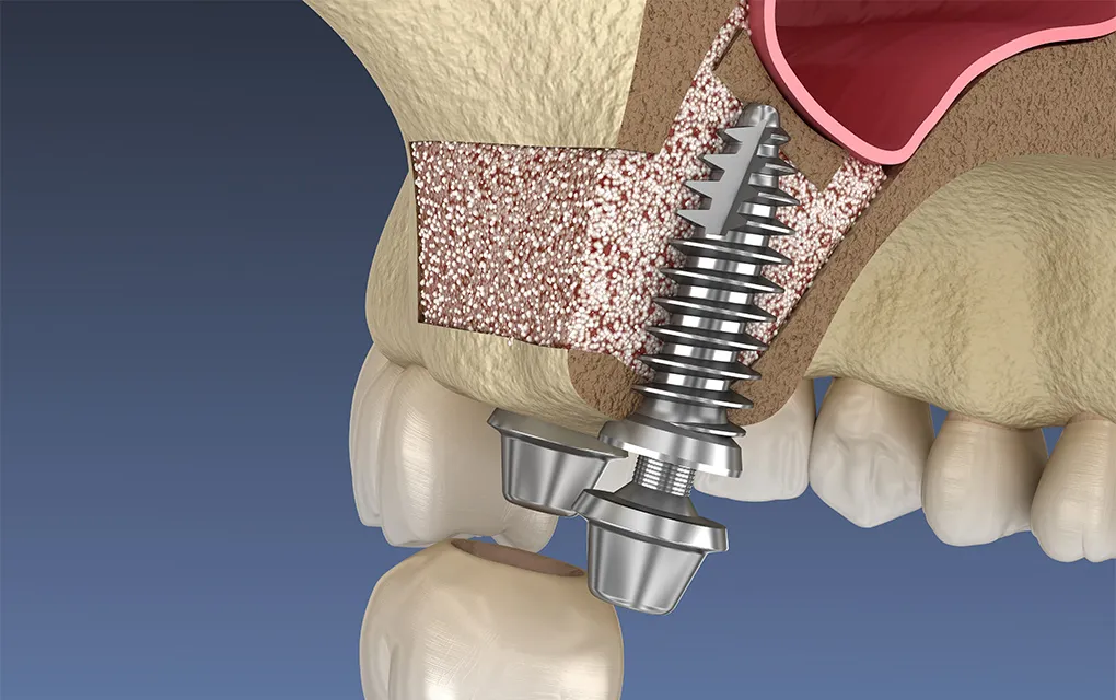 サイナスリフト