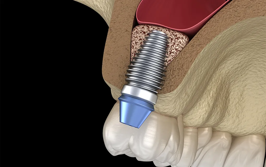ソケットリフト