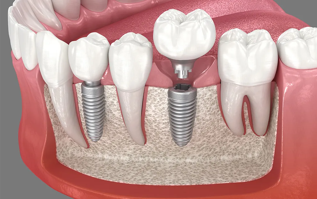 抜歯即時埋入（低侵襲インプラント）