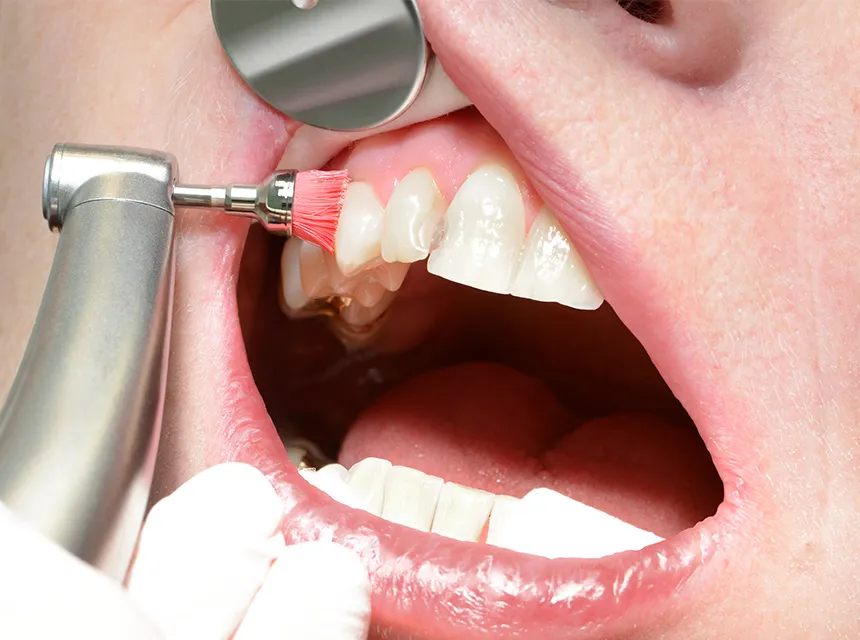 定期検診とクリーニング