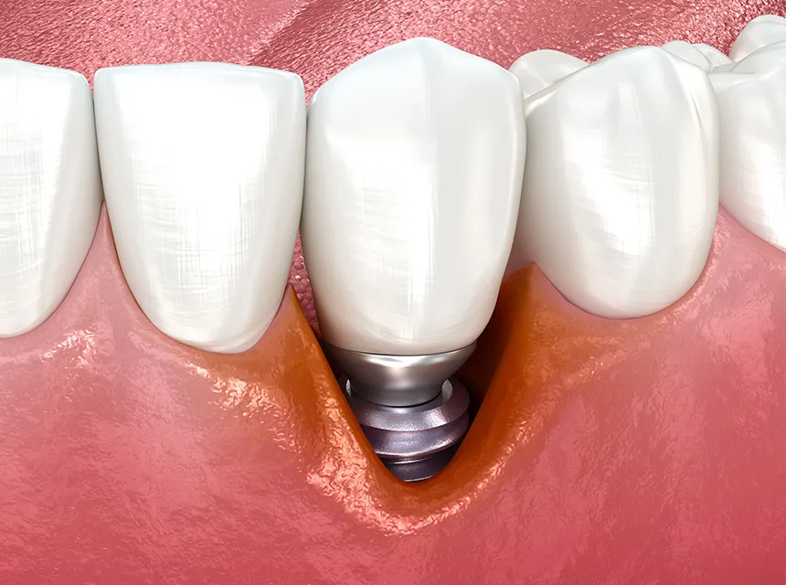 「インプラント周囲炎」とは