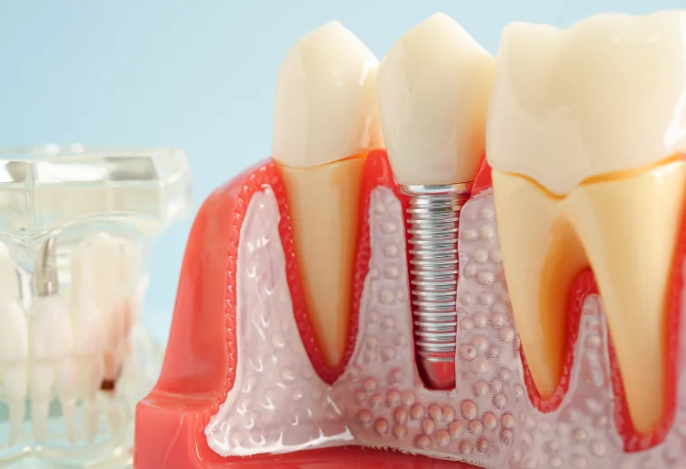 上部構造の作製・装着