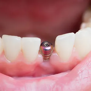 インプラントを入れたい