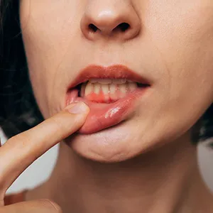 歯周病を予防したい