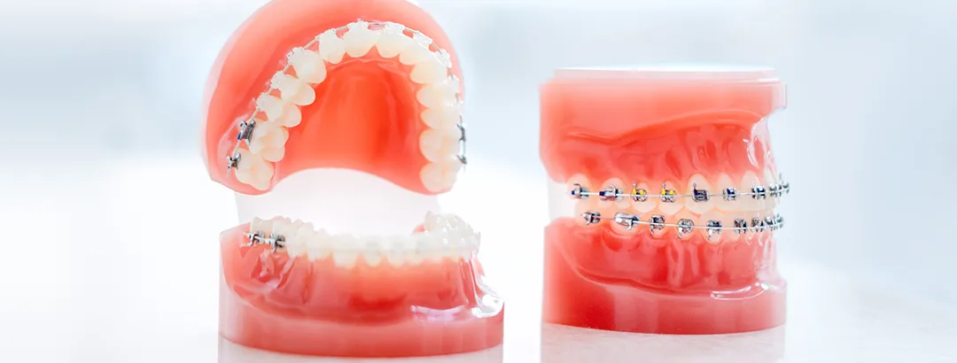ワイヤー矯正とは