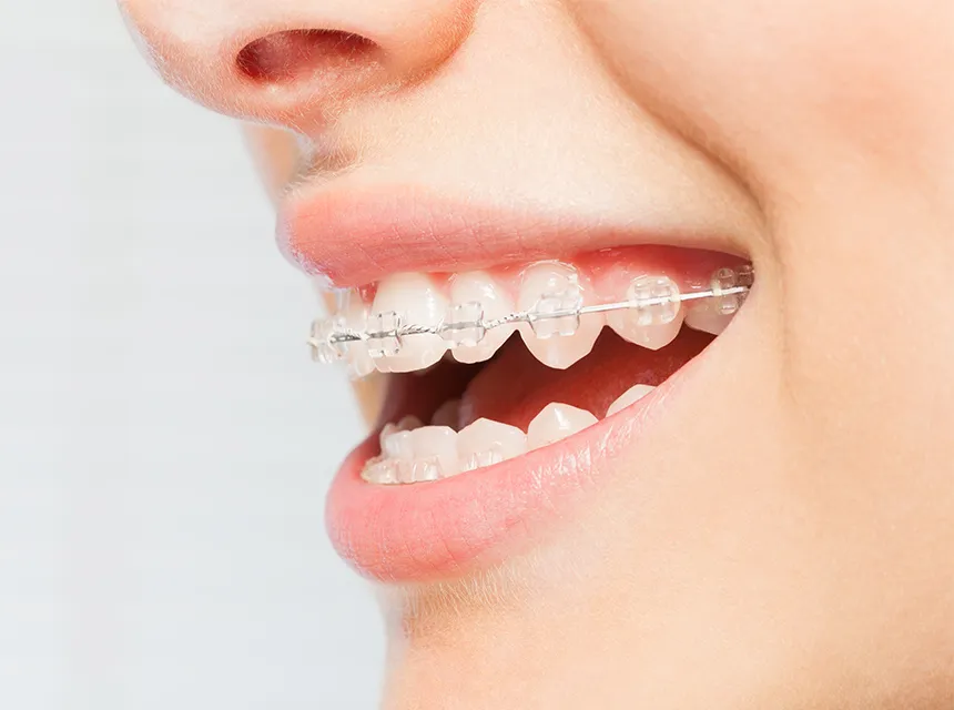 唇側（表側）矯正