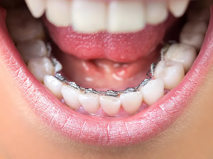 舌側（裏側）矯正